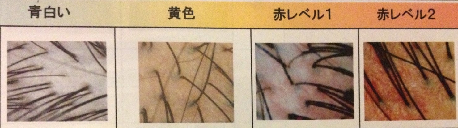 頭皮 赤い斑点 741